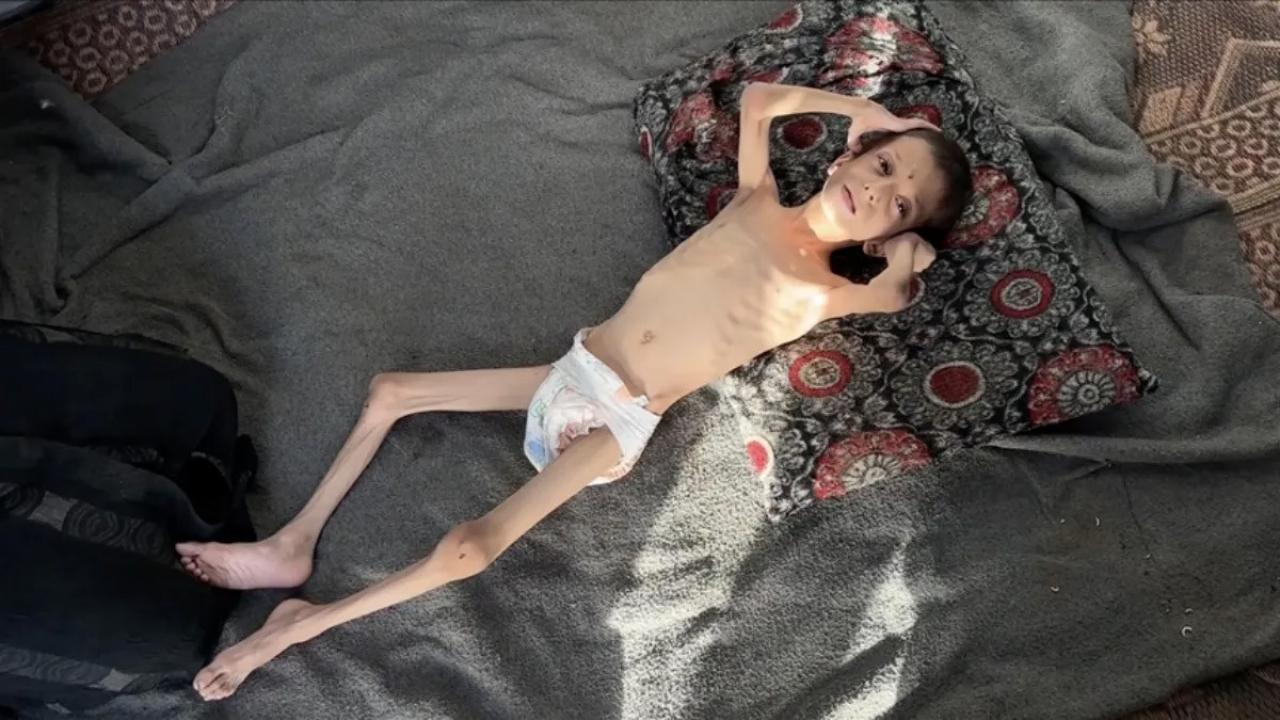 10 yasindaki gazzeli nafiz 4 aylik bebege donustu annesi tasimaya bile korkuyor ZPbEUdGX